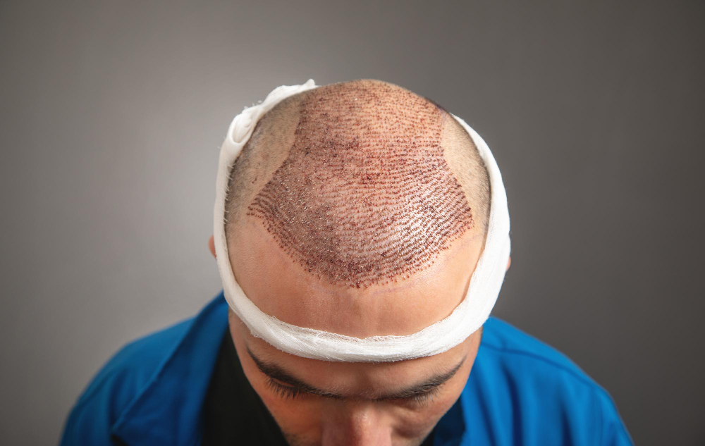 The SMP Healing Process: Your Complete Aftercare Guide for Long-Lasting Results